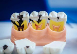 Model rozwoju choroby zęba.